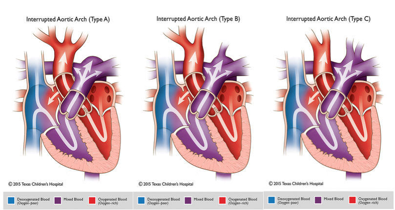 Interrupted Aortic Arch Pediatric Echocardiography